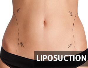 Liposuction
