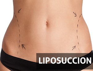 Liposuccion