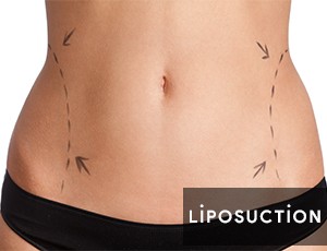 Liposuction