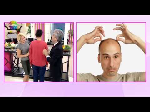 Doç. Dr. Hayati Akbaş - Saç Ekim Operasyonu Nasıl Yapılır? Show Tv