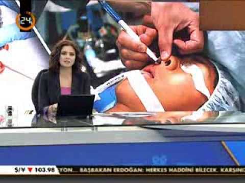 Doç.Dr.Hayati Akbaş - Burun Estetiği - Kanal 24 Haber Bülteni